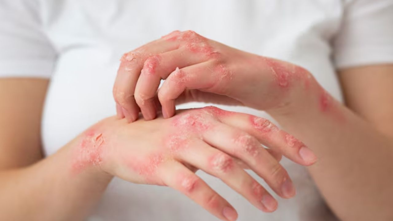eczema