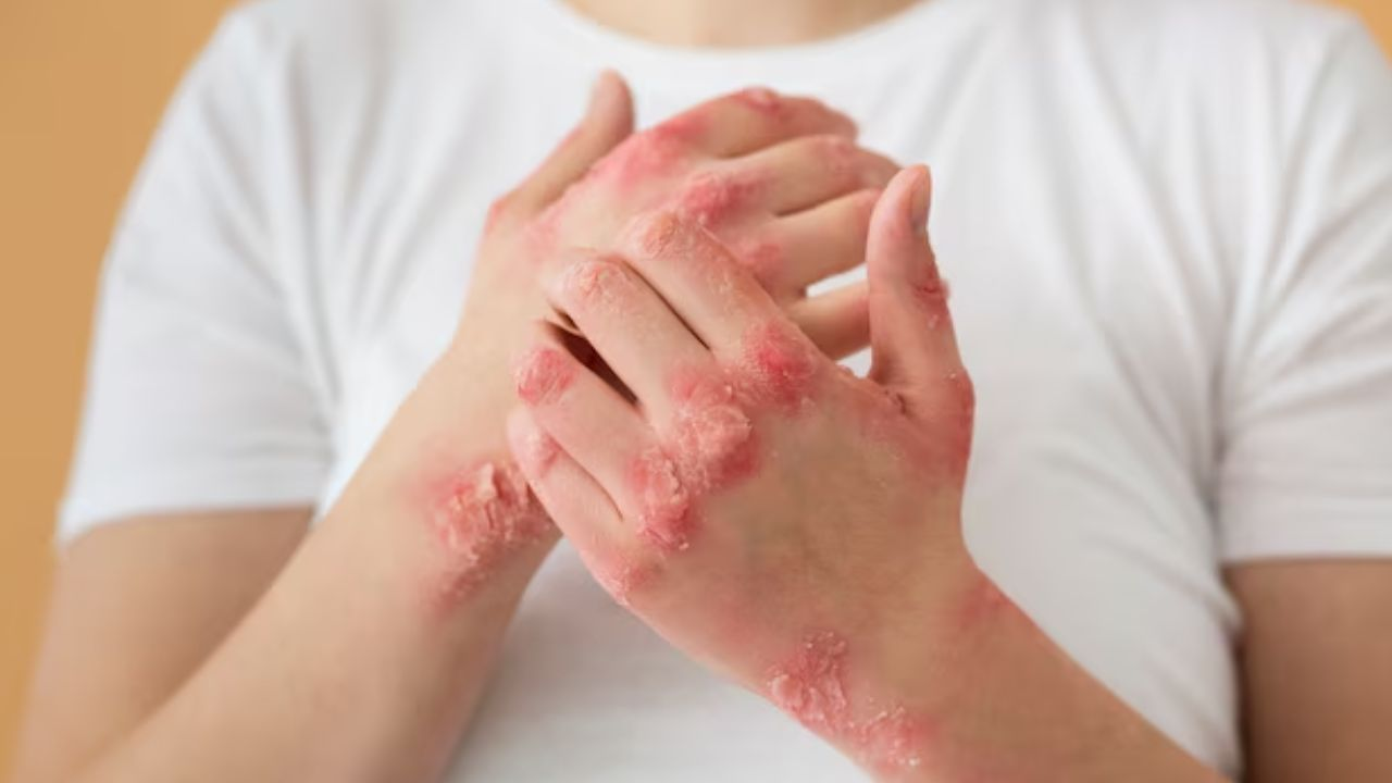 Eczema