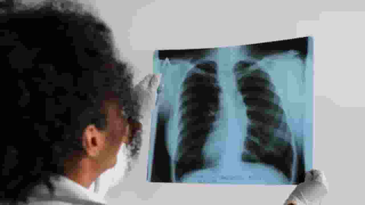 tuberclosis