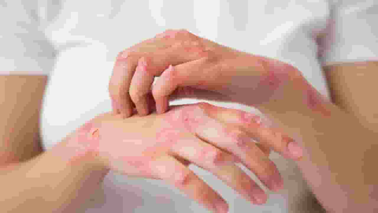 एक्जिमा आपकी सेहत के लिए खतरा क्यों है? eczema