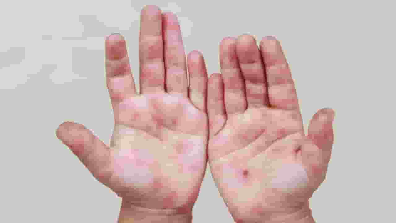 दिल्ली एनसीआर में इस वायरल बीमारी के मामले बढ़े, जानें लक्षण और बचाव Hand foot mouth disease