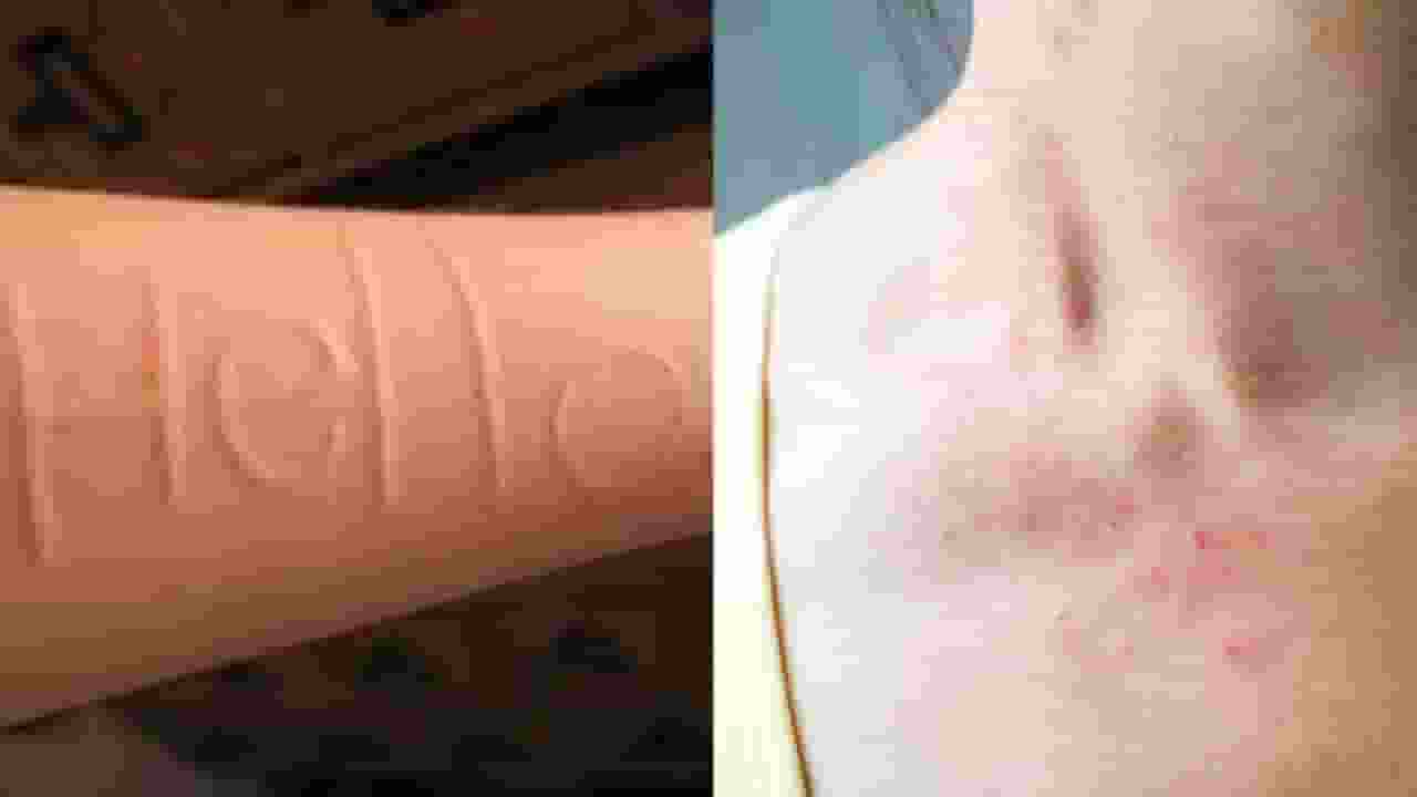 डर्मेटोग्राफिया बीमारी में त्वचा पर लिख सकते हैं शब्द, जानिए लक्षण
 skin writing disease